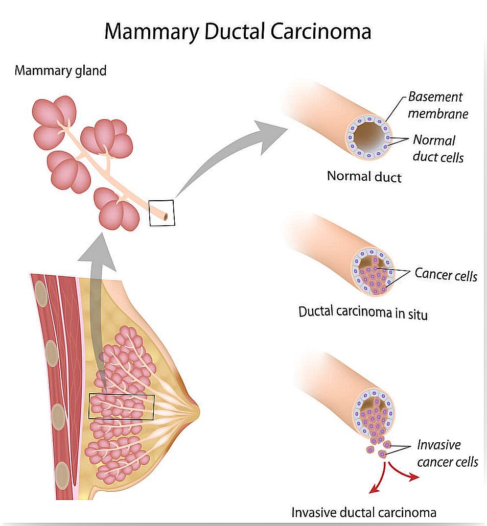 Biology of breast cancer: origin and types.