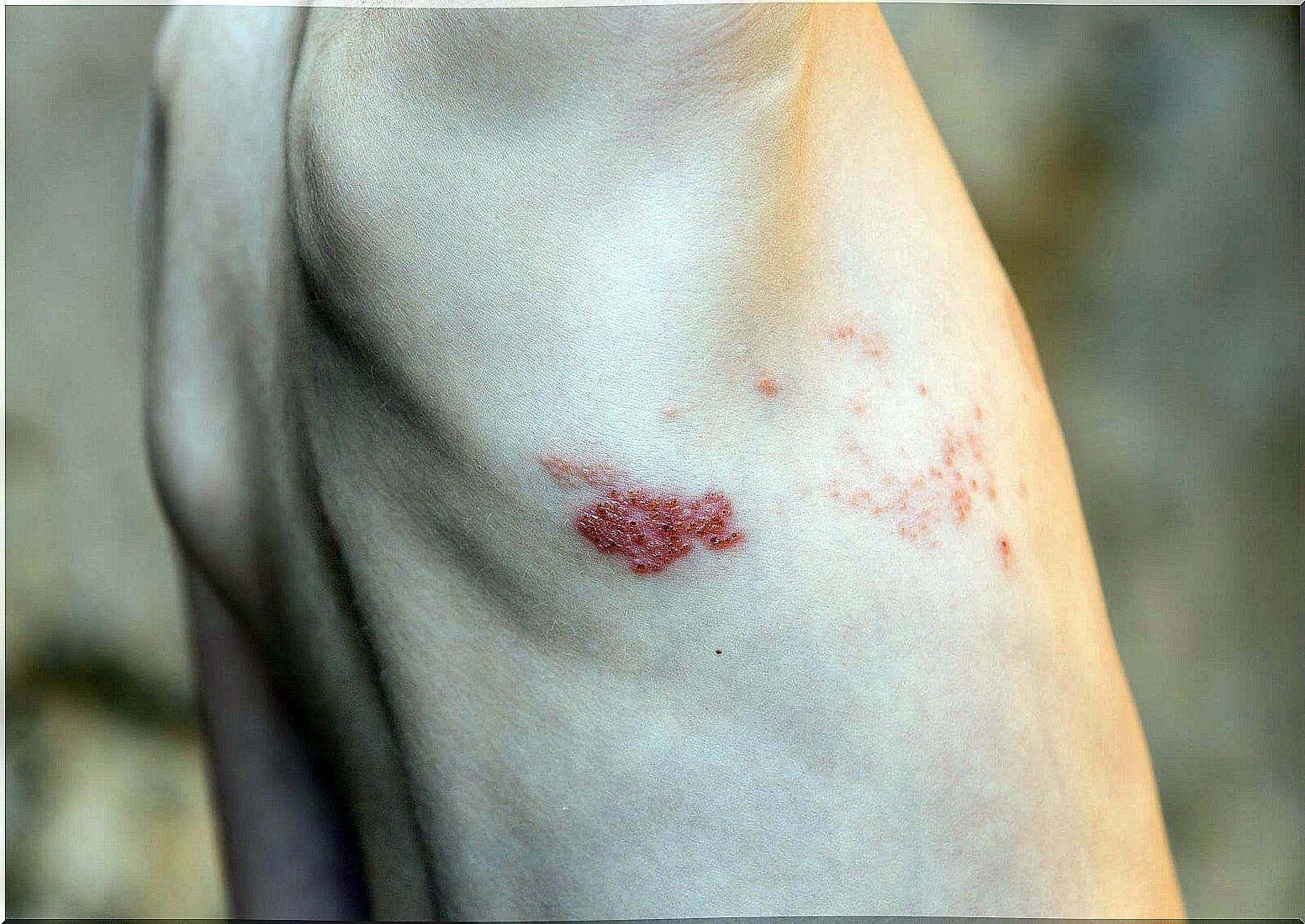 Child with impetigo, one of the skin infections.