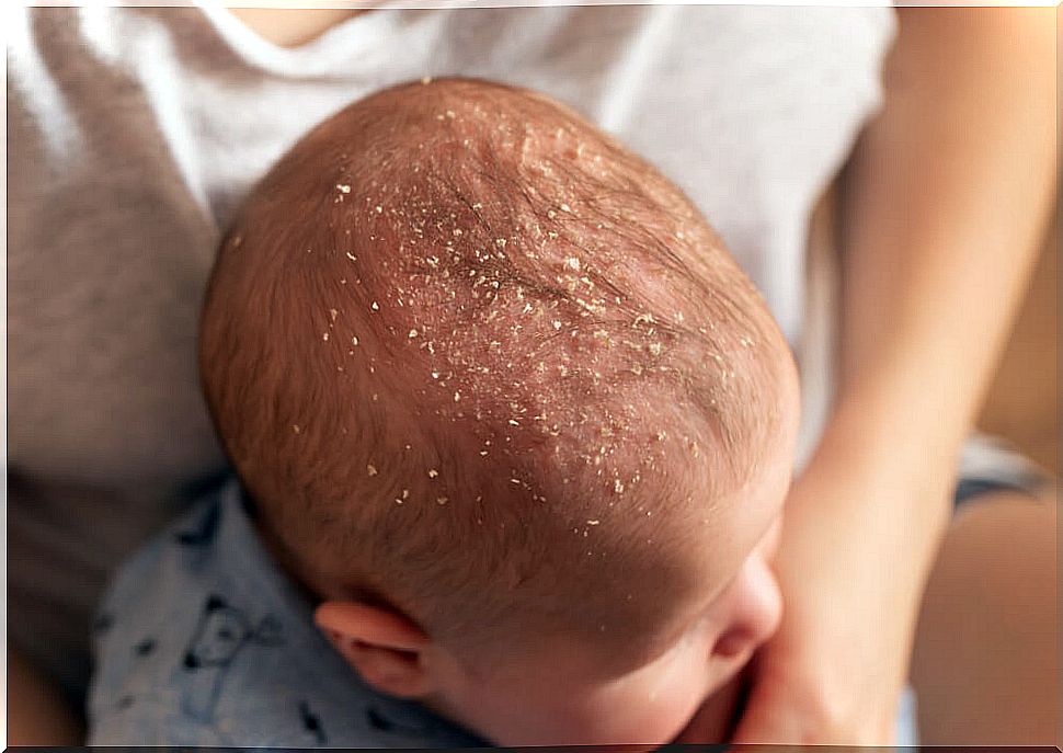 Curiosities about cradle cap