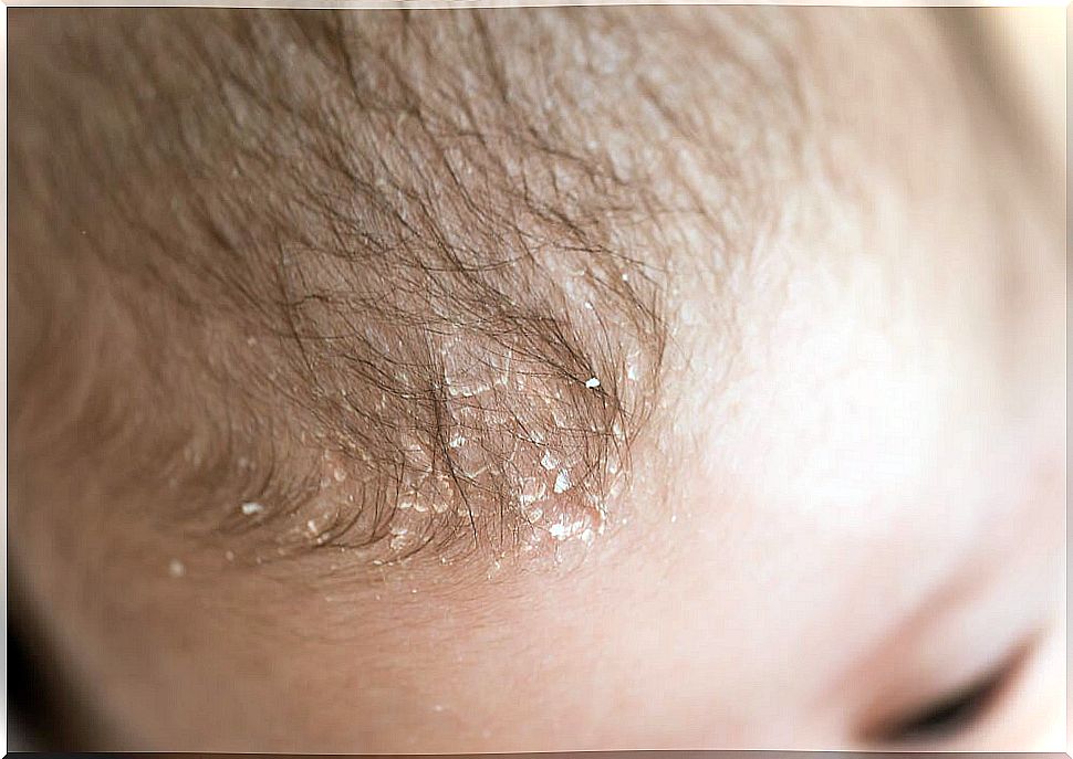 Baby with cradle cap or seborrheic dermatitis.