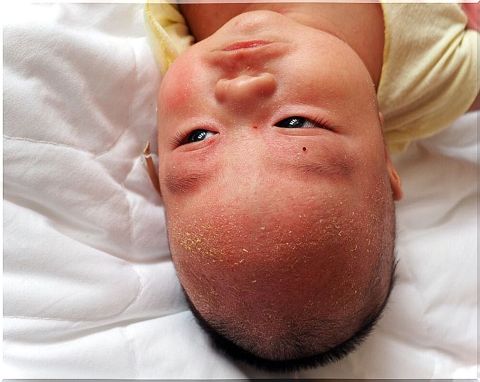 Baby with cradle cap or seborrheic dermatitis.