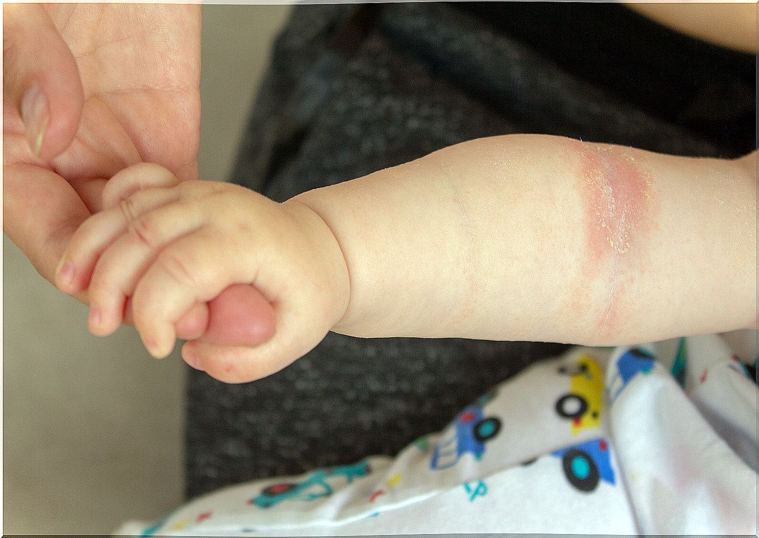 Feeding and eczema in babies