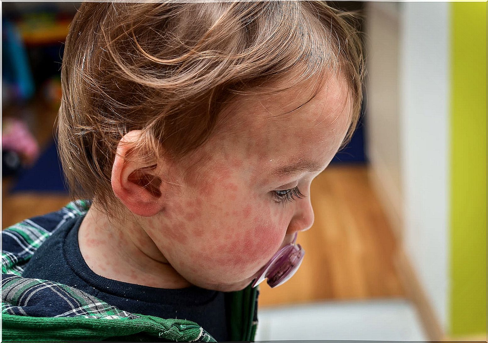 Child with dermatitis due to the relationship between diet and eczema in babies.