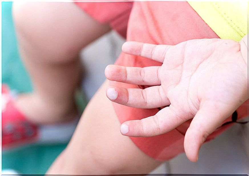 How to cure blisters in children?