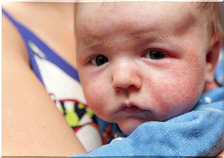 How to fight baby rashes?