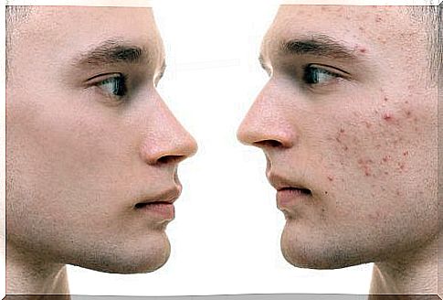 There are several types of acne and not all have the same treatment.